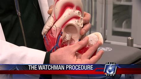 Cutting-edge Watchman procedure used to correct A-Fib - YouTube