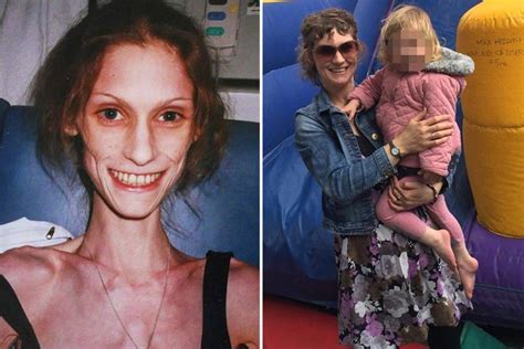 Brave Mum Who Dropped To Just Four Stone While Battling Anorexia Has