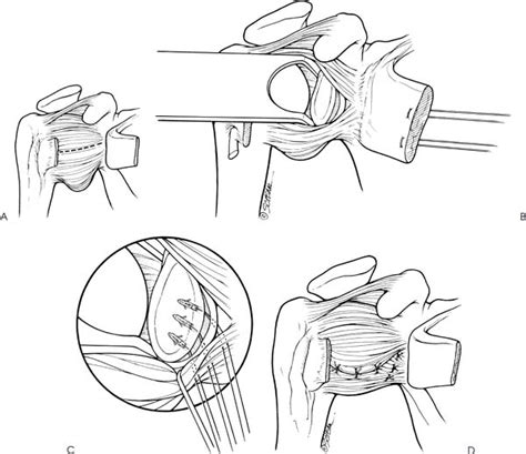 Details More Than 56 Pants Over Vest Suture Technique Latest Ineteachers