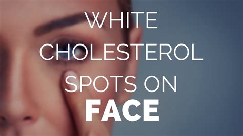 White Cholesterol Spots On Face How Do I Remove Them Youtube