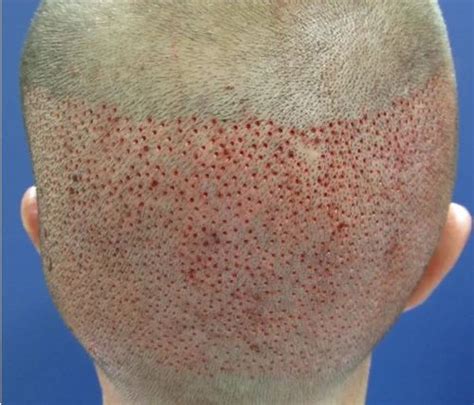 Follicle Hair Transplant At Rs 50 Graft In Mumbai ID 10795891233