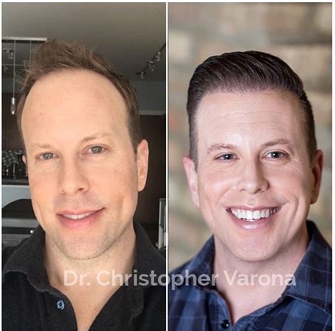 Fue Hair Transplant Before And After Photos Heidy Chamberlain