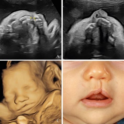 Unilateral Cleft Lip And Palate Visualized On Ultrasound During The