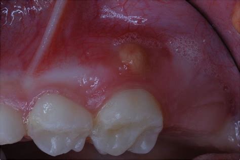 Focal Gum Lesions Visual Diagnosis And Treatment In Pediatrics 3 Ed