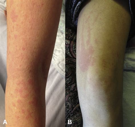 Reactive Hemophagocytic Syndrome In A Patient With Adult Onset Still