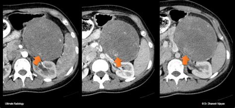 Ultimate Radiology Solid Pseudopapillary Tumor Of Pancreas