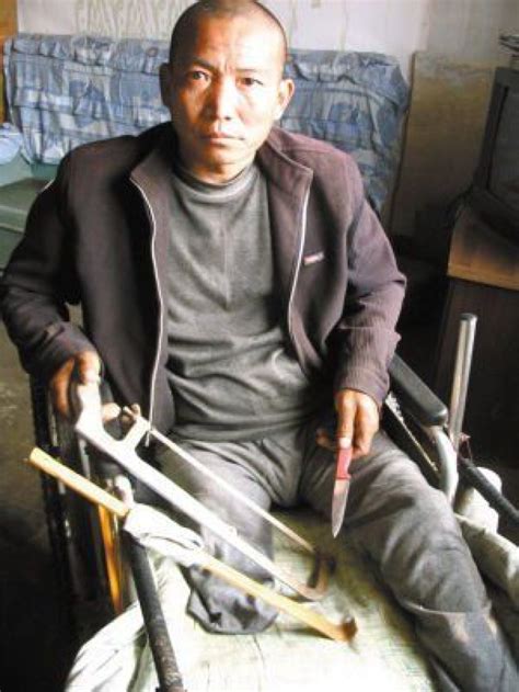 Man In China Amputates Own Leg With Small Saw And Butter Knife Photo