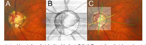 Figure 1 From Lamina Cribrosa Configuration In Tilted Optic Discs With