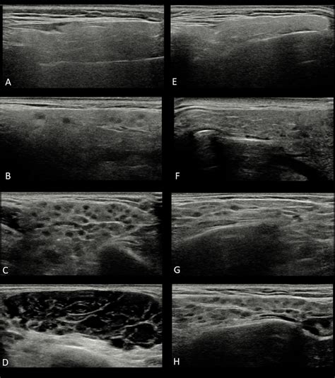 Ultrasound Images Of Parotid Glands In The Two Four Grade