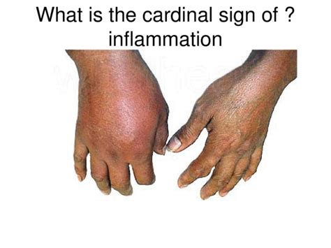 Heat results from increased blood flow through the area and is experienced only in peripheral parts of the. INFLAMMATION. What is the cardinal sign of ?inflammation