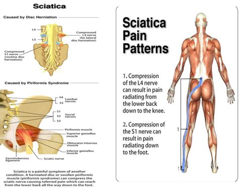 Sciatica In Econdido Ca Heilman Chiropractic And Spinal Decompression