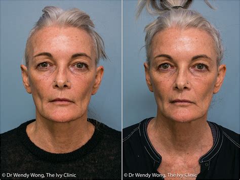 Cosmetic Before And After Gallery Dr Wendy Wong