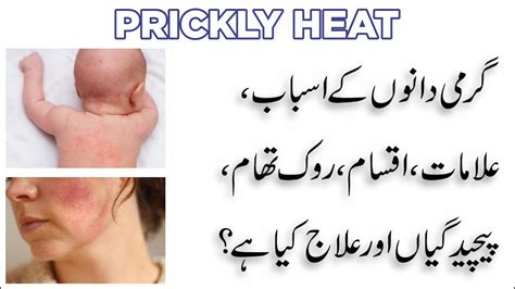 Prickly Heat گرمی دانے Causes Symptoms Types Prevention And