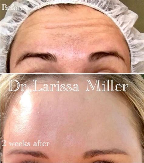 Forehead Before And After Vista Clinic Melbourne