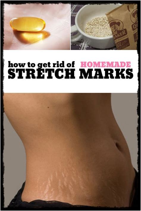 How To Get Rid Of Stretch Marks By Magazinez Net Health Beauty