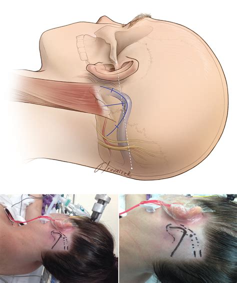 Microvascular Decompression For Hemifacial Spasm The Neurosurgical Atlas