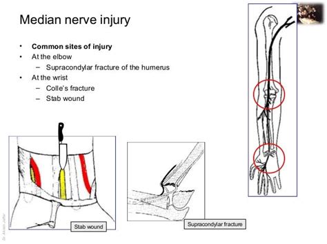 Applied Anatomy Median Nerve Injury