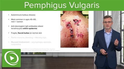 Pemphigus Vulgaris Dermatology Lecturio Youtube