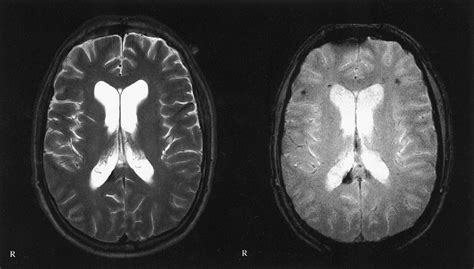 Diffuse Axonal Injury Associated With Chronic Traumatic Brain Injury