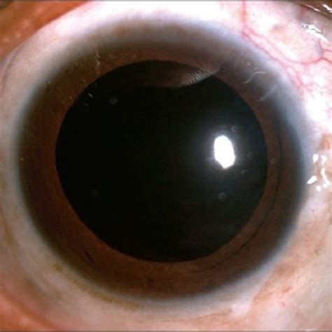 Pdf Linguatula Serrata In The Anterior Chamber Of The Eye