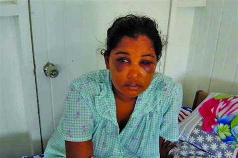 Woman Severely Beaten By Husband Refuses To Press Charges Guyana Times
