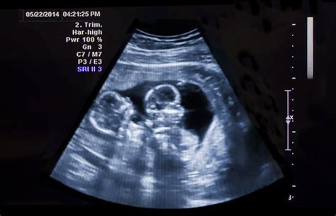 Ultraschall Schwangerschaft 5woche Zwillinge Perry Platyphus