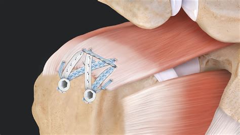 Supraspinatus Rotator Cuff Surgery Sexiz Pix