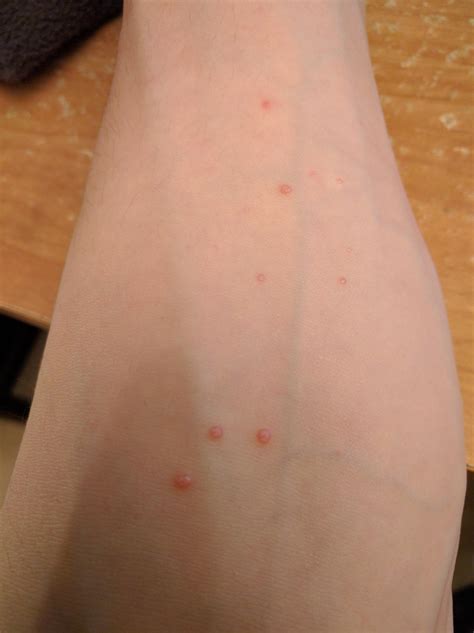 Skin Concerns What Are These Red Bumps On My Arm And How Do I Get Rid