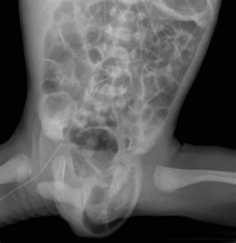 Inguinal Hernia Radiograph Radiology Case Radiopaedia