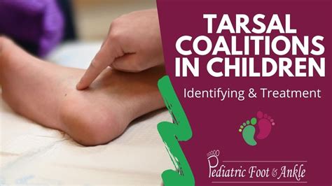 Identifying And Treating Tarsal Coalitions In Children Youtube
