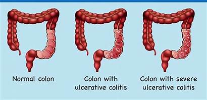 Colitis Ulcerative Diagram Showing Colon Normal Disease