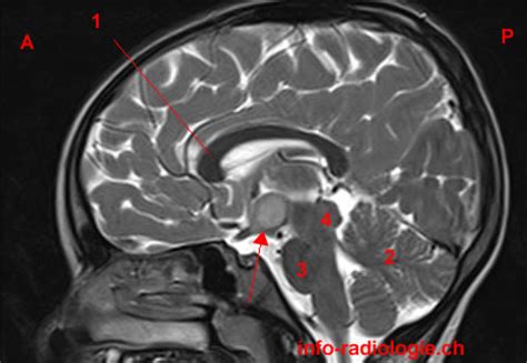 Normal yapılı dokuların yer olarak uygun olmayan lokalizasyonlarda bulunması sonucu oluşan tümör benzeri yapılış bozukluğu. Hamartome hypothalamus