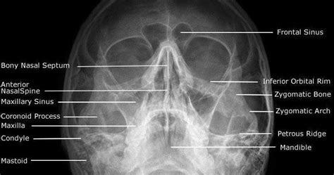 Diagnostic Medical Imaging Waters View X Ray Paranasal Sinuses