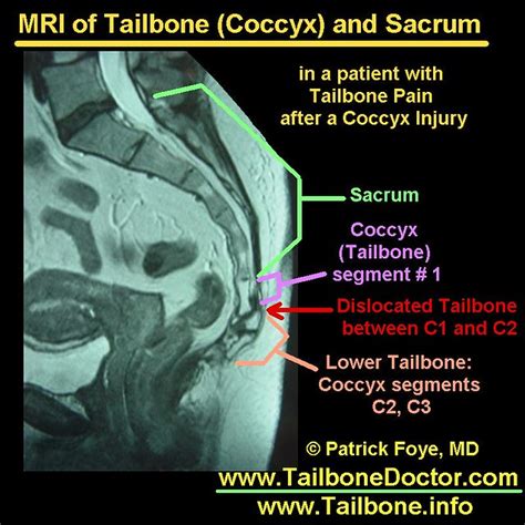 Tailbone Mri Coccyx Dislocation Tailbone Pain Tailbone M Flickr