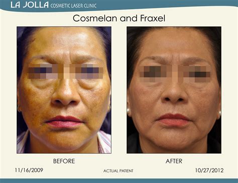 Patient Treated With Cosmelan And Fraxel At La Jolla Cosmetic Laser