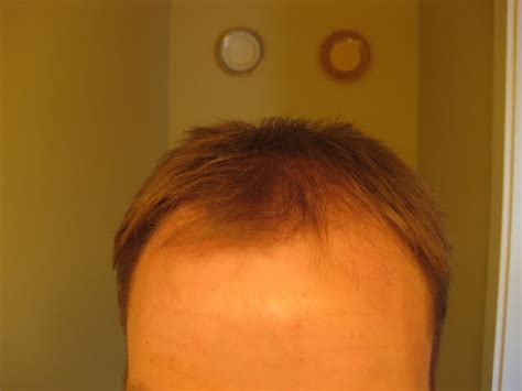 .does serum go before moisturizer custom, should i apply serum before moisturizer, difference between toner and serum manufactures, does serum go on before moisturizer, how to use serum and cream, face serum before or after moisturizer, when do you apply serum suppliers. nanogen, before and after pics | HairLossTalk Forums