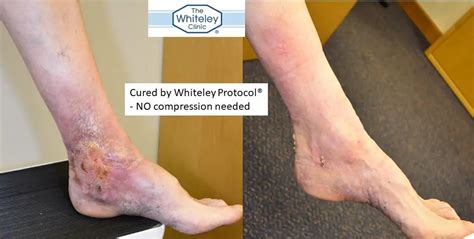 Venous Leg Ulcer Cured Without Compression The Whiteley Clinic