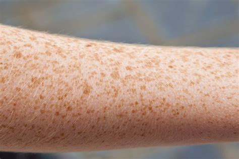 Skin Lesions Types Pictures Diagnosis Treatment And More