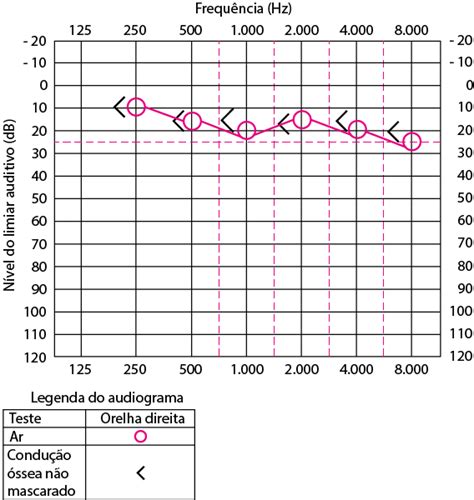 Figure Audiograma Da Orelha Direita Em Paciente Com Audição Normal
