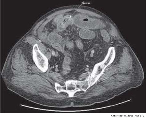 Gallstone Ileus One Quarter Of A Century Post Cholecystectomy Annals
