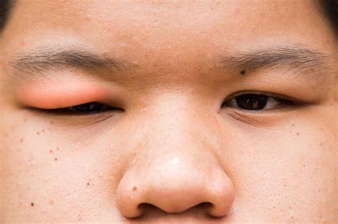 12 Causes And Treatments Of A Swollen Eyelid Stye Chalazion Allergies