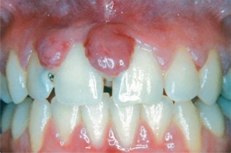Classification Of Periodontal And Peri Implant Diseases Flashcards