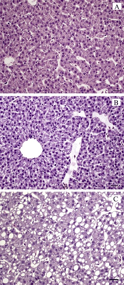 Liver Histology Micrographs Showing Different Degrees Of Steatosis A