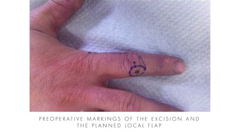 Malignant Melanoma Excision Finger Rhodes Greece Youtube