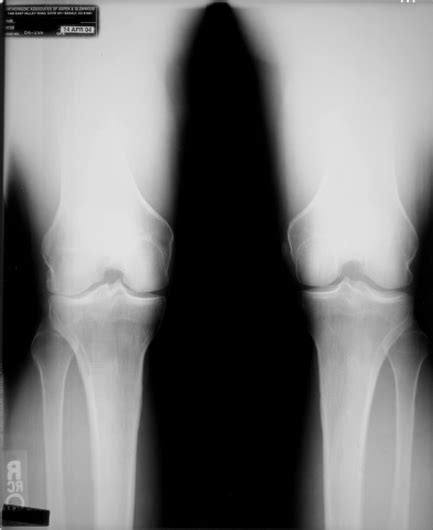 Degenerative Knee Bone On Bone Will Regenerate The Posture Clinic