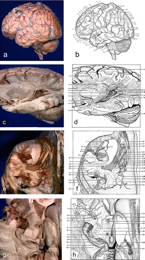 Brain Surface Lateral Aspect A The Arachnoid Membrane Is Intact Note Download Scientific