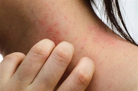 Dermatite Da Sudore Sintomi Cause E Rimedi Eucerin