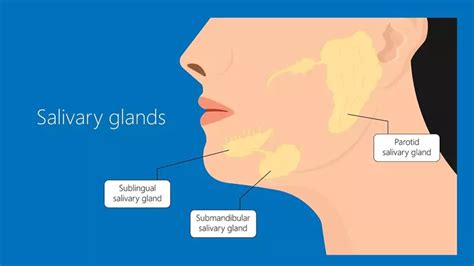 Submandibular Gland Cancer Oralmed
