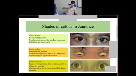 Jaundice Hyperbilirubinemia By General Hospital Neighrims Shillong