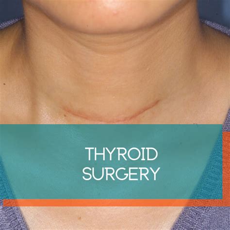 Pin On Thyroid Surgery
